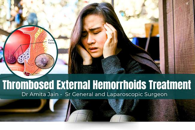 Thrombosed External Hemorrhoid piles treatment by Dr Amita Jain